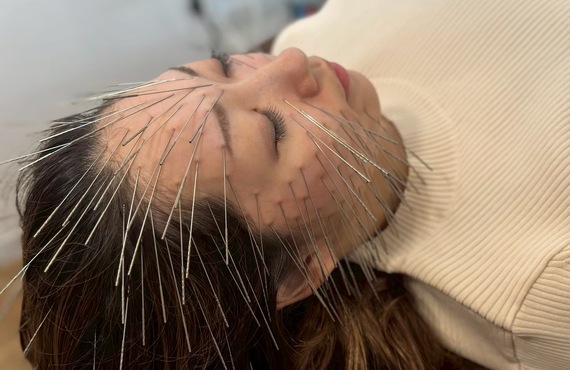 細胞レベルの美肌革命を起こす美容鍼|ひなた治療院/整体院